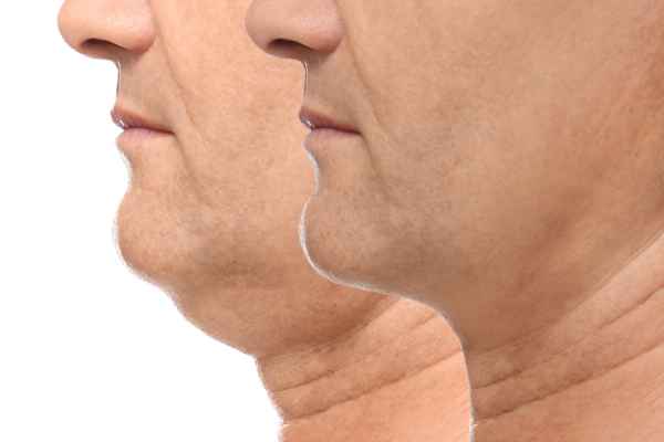 HIFU - Breakthrough in Anti - ageing 2 hifu results Newport