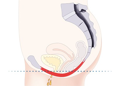 Pelvic-Floor Muscle Repair 5 Pelvic floor muscles Newport