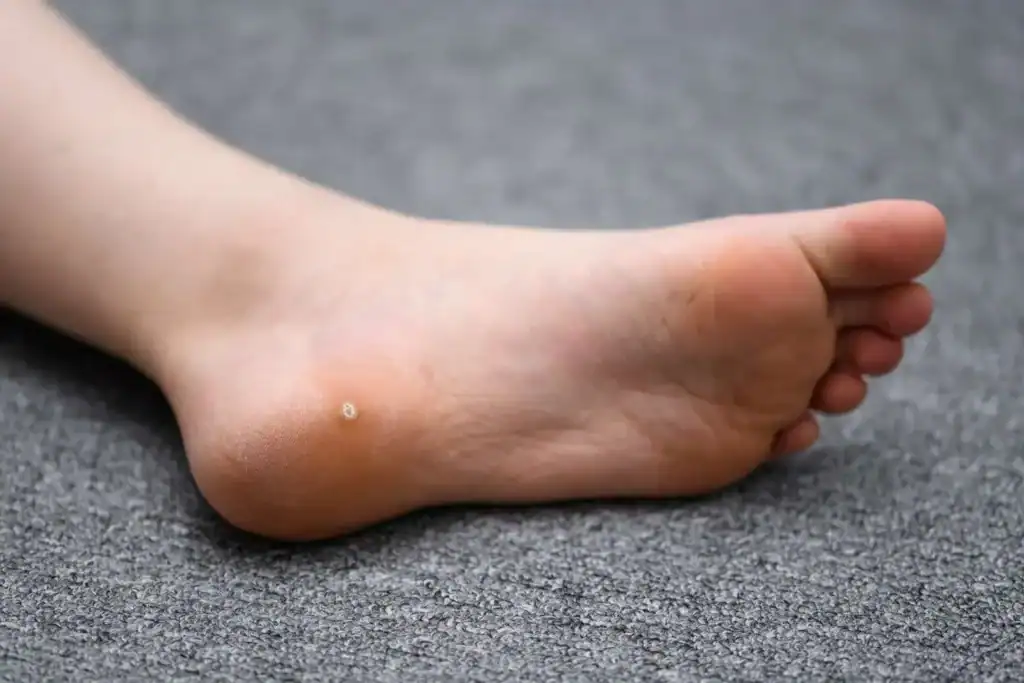 Cryotherapy For Warts And Also Verrucas 2 Image of verruca on the bottom of the foot that able to be treated with Cryotherapy Newport