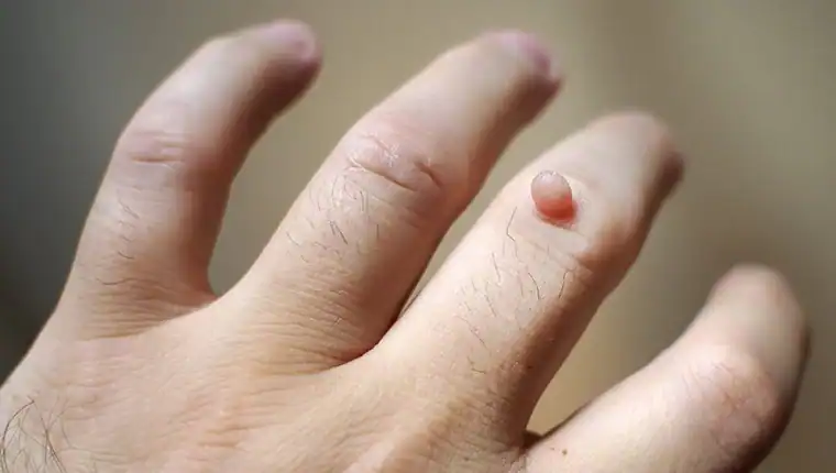 Cryotherapy For Warts And Also Verrucas 1 Image of blemish that Cryotherapy Newport can remove with Lipo 360.