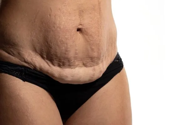 The science behind skin tightening Newport picture of a woman's sagging skin on the stomach